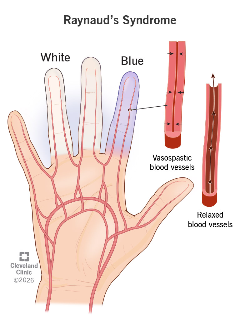 Hand with white and blue fingers due to Raynaud’s syndrome