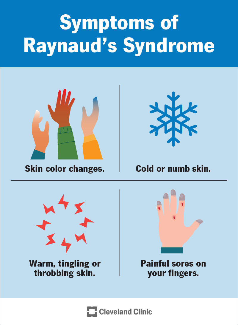 Illustration showing Raynaud's symptoms. These include skin color changes and discomfort as blood flow is interrupted.