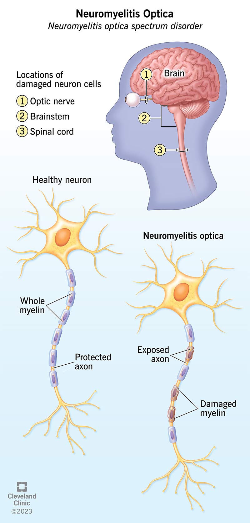 MS Attack (Relapse): Symptoms, Triggers, What To Do