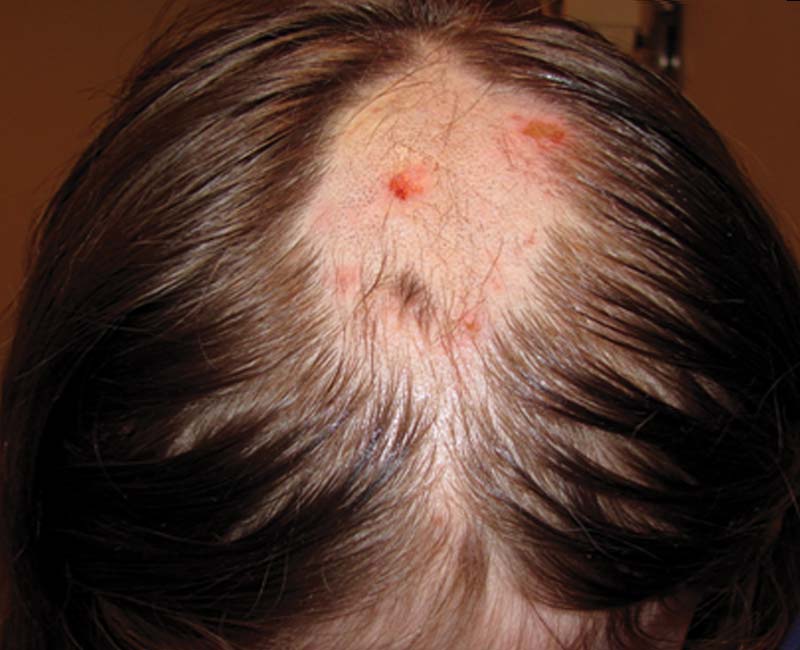 An area with missing hair due to trichotillomania (photo used with permission by “Cleveland Clinic Journal of Medicine”).