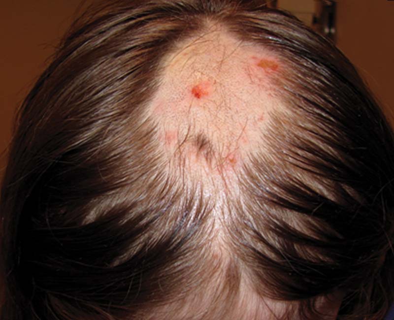 https://my.clevelandclinic.org/-/scassets/images/org/health/articles/9880-trichotillomania