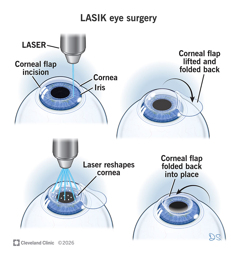 LASIK surgery reshaping cornea