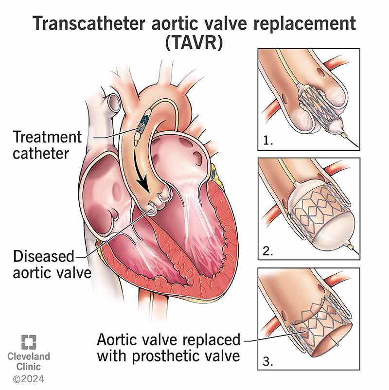 TAVR is a procedure to replace your aortic valve without surgery. A provider uses a catheter to place the new valve