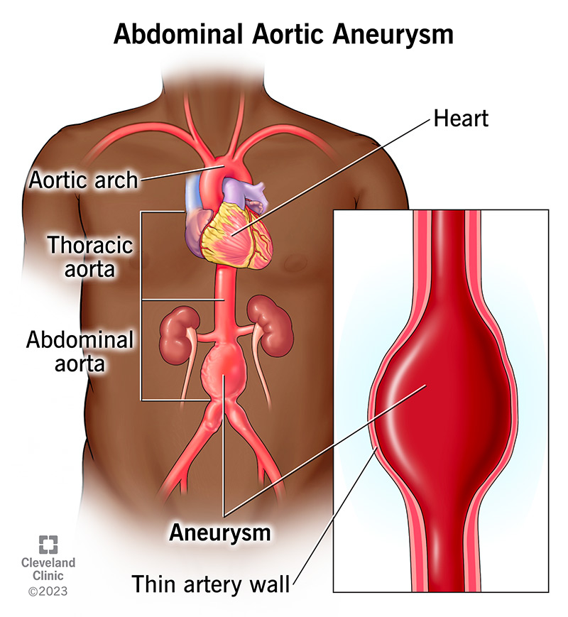 Illustration shows an enlargement or bulge in the abdominal aorta. This bulge is an abdominal aortic aneurysm.