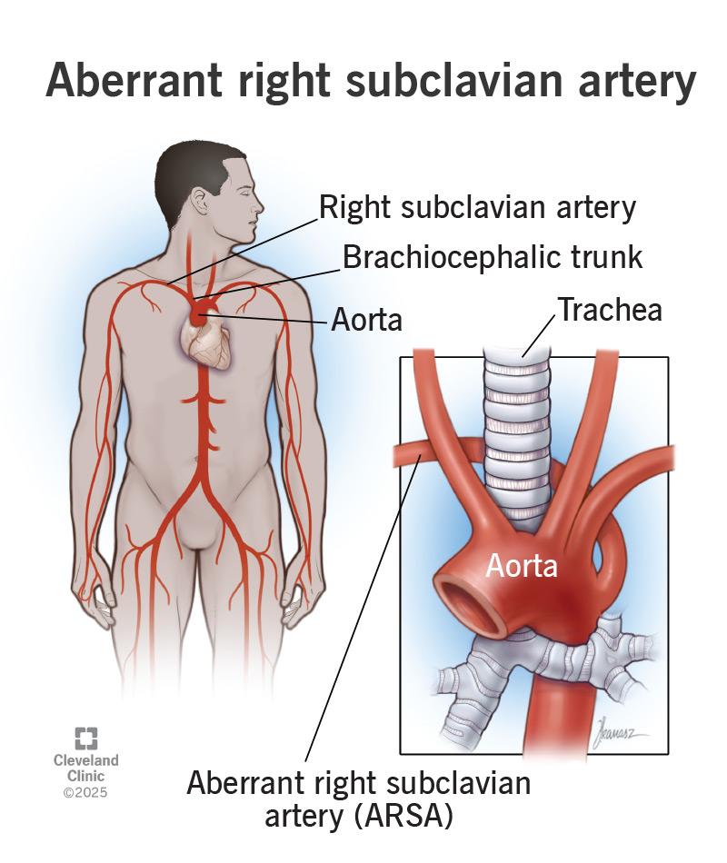 Anatomy of a normal and an aberrant right subclavian artery, with aorta, trachea, brachiocephalic trunk