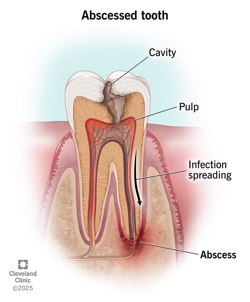 A periapical tooth abscess from a cavity that’s spreading infection throughout the tooth