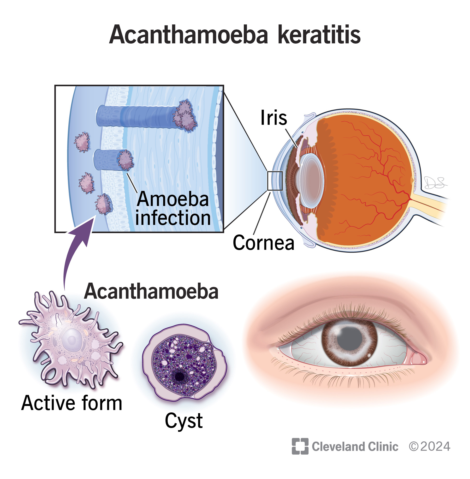 Acanthamoeba keratitis happens when microscopic parasites infect the cornea at the front of your eye.