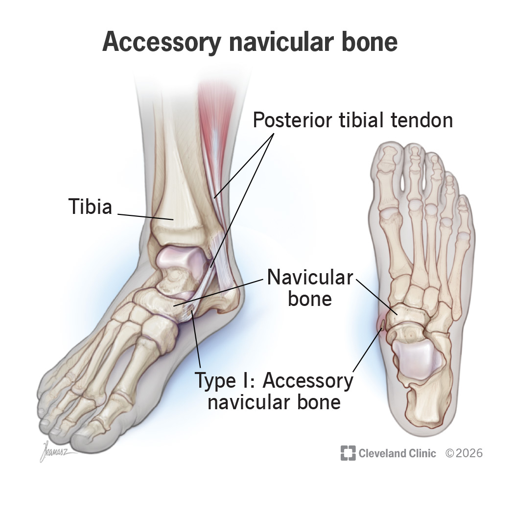 An accessory navicular bone is an extra bone that forms in your foot