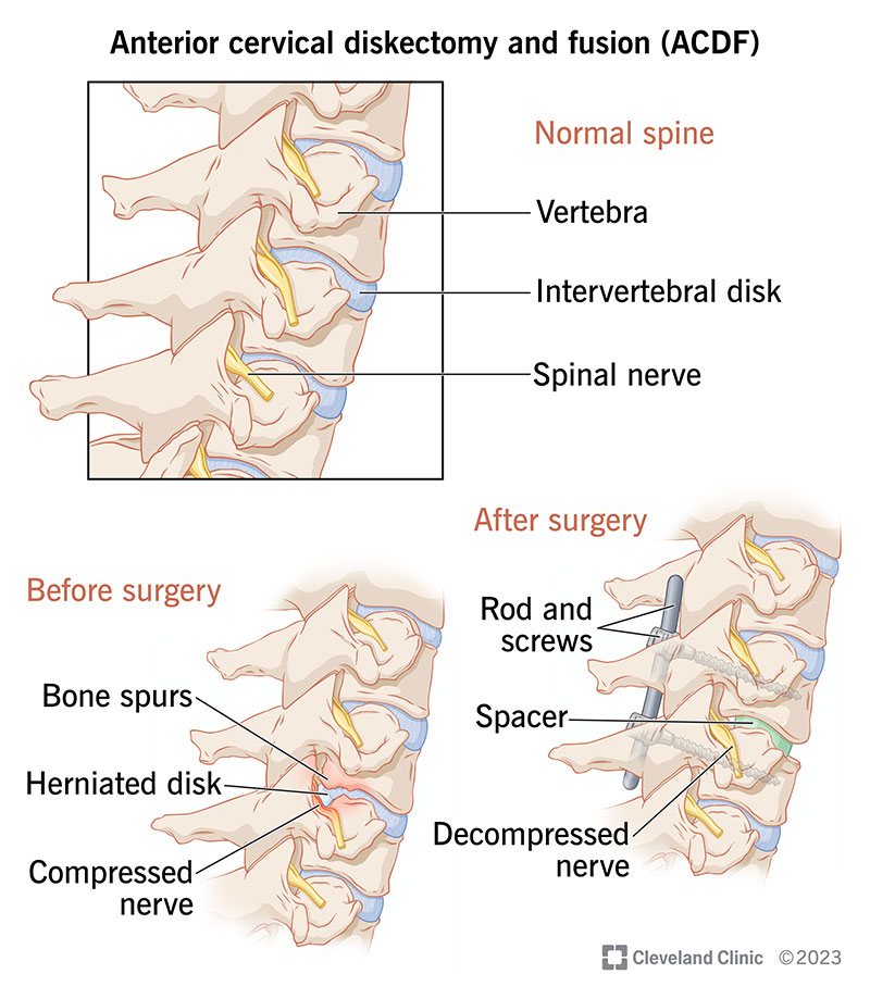 The spinal bones before and after anterior cervical diskectomy and fusion surgery.