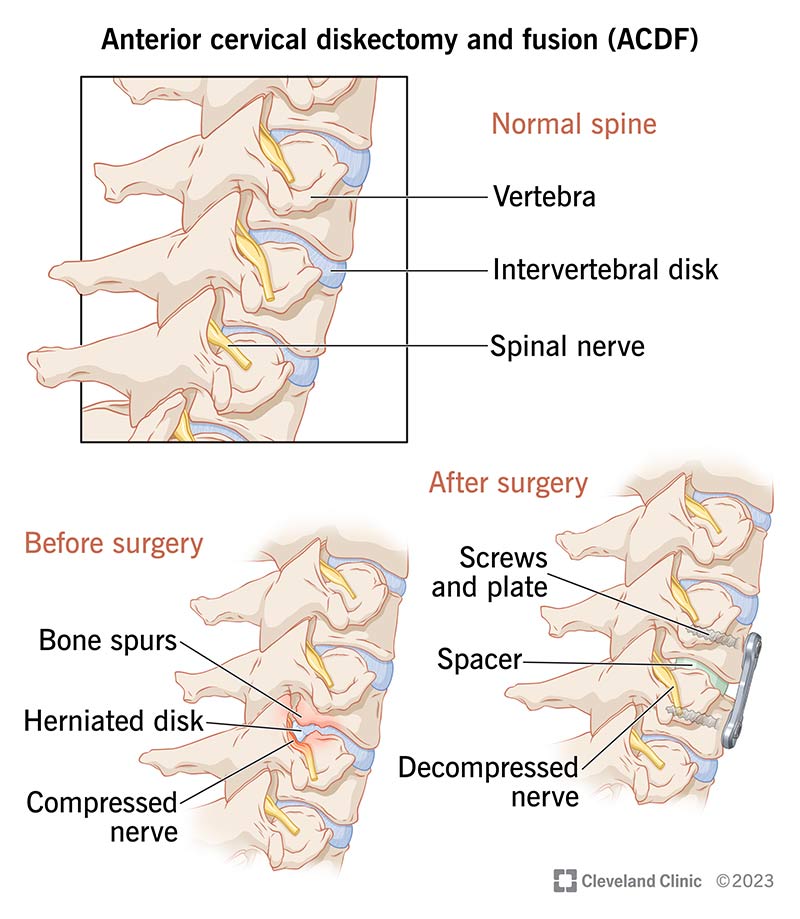 The spinal bones before and after anterior cervical diskectomy and fusion surgery.