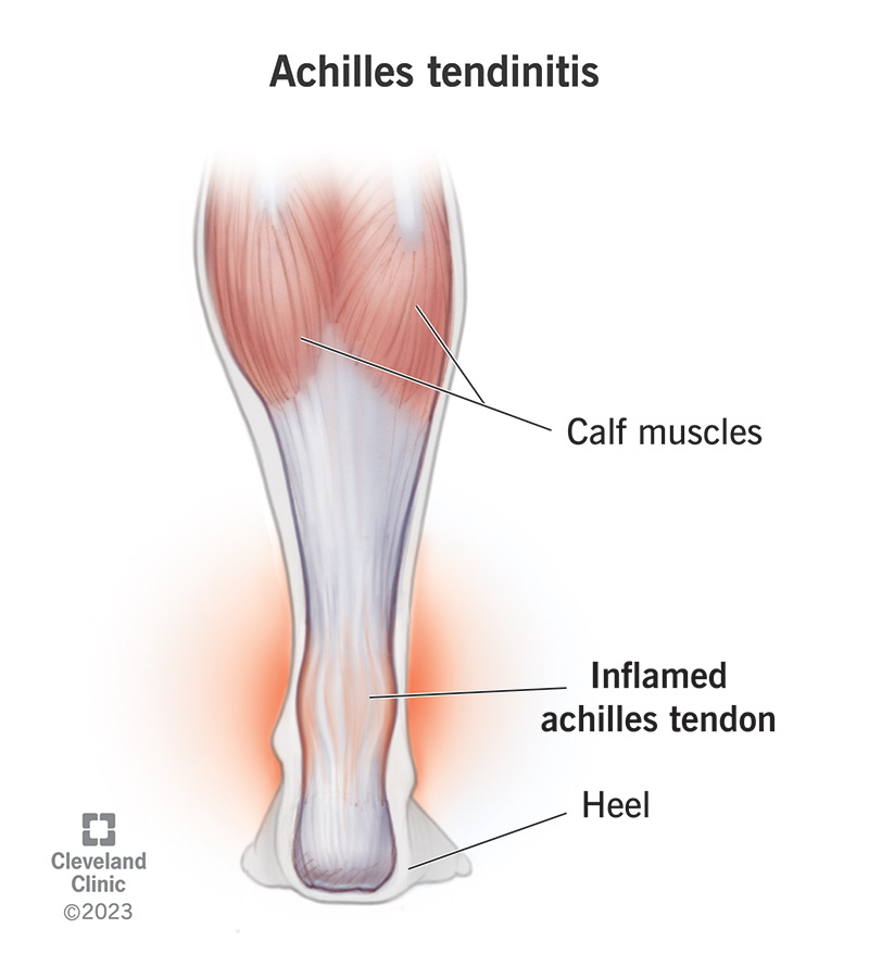 An inflamed Achilles tendon