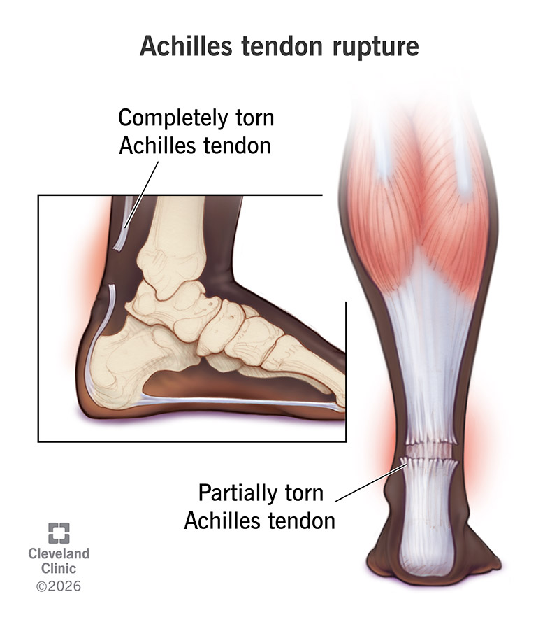 Comparison of partial and complete Achilles tendon rupture