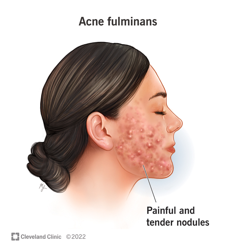 Symptoms of acne fulminans on a person’s chin and cheek