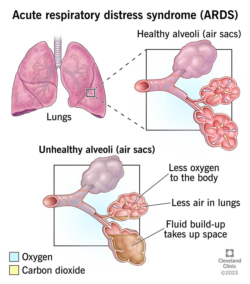 Healthy air sacs (alveoli) in a person's lungs compared to unhealthy air sacs filled with fluid and low oxygen levels.