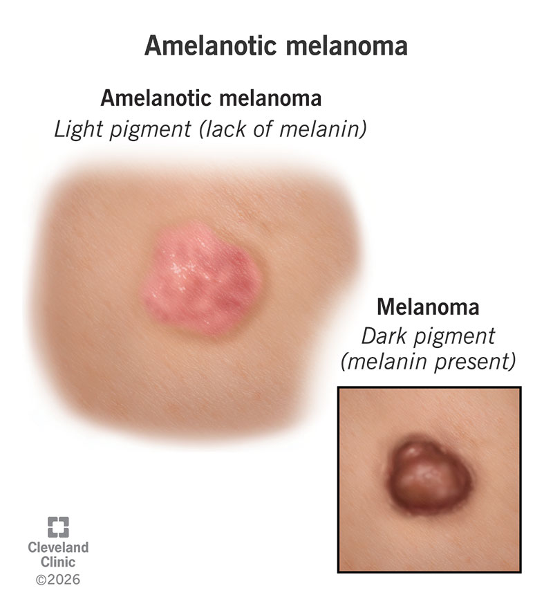 non melanotic melanoma Amelanotic Melanoma: Symptoms, Diagnosis & Stages