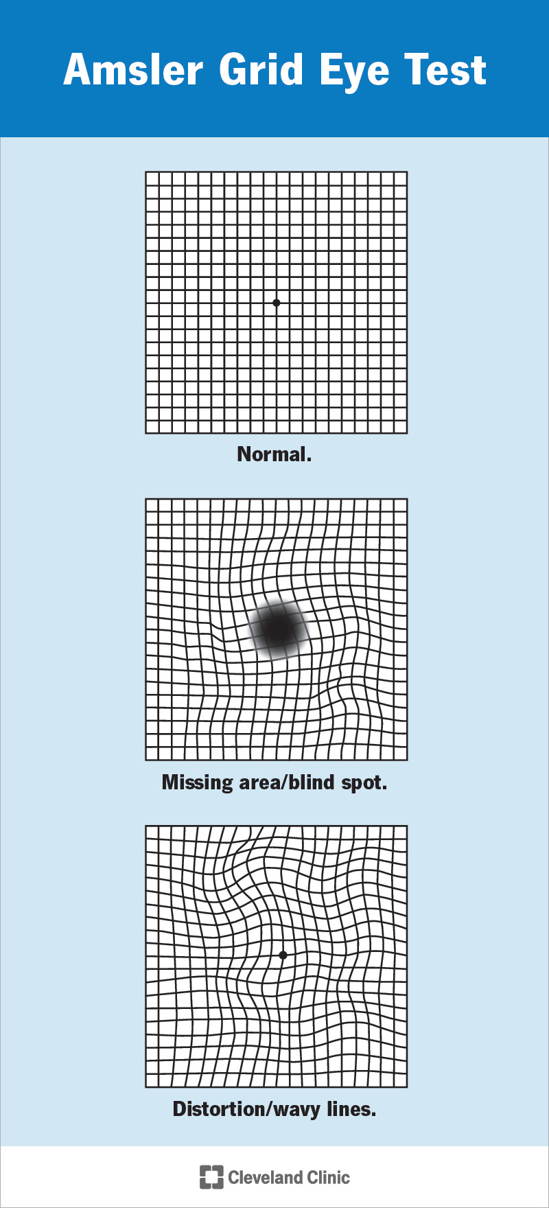 The Amsler grid eye test makes it easier to see distortions or gaps in your vision.