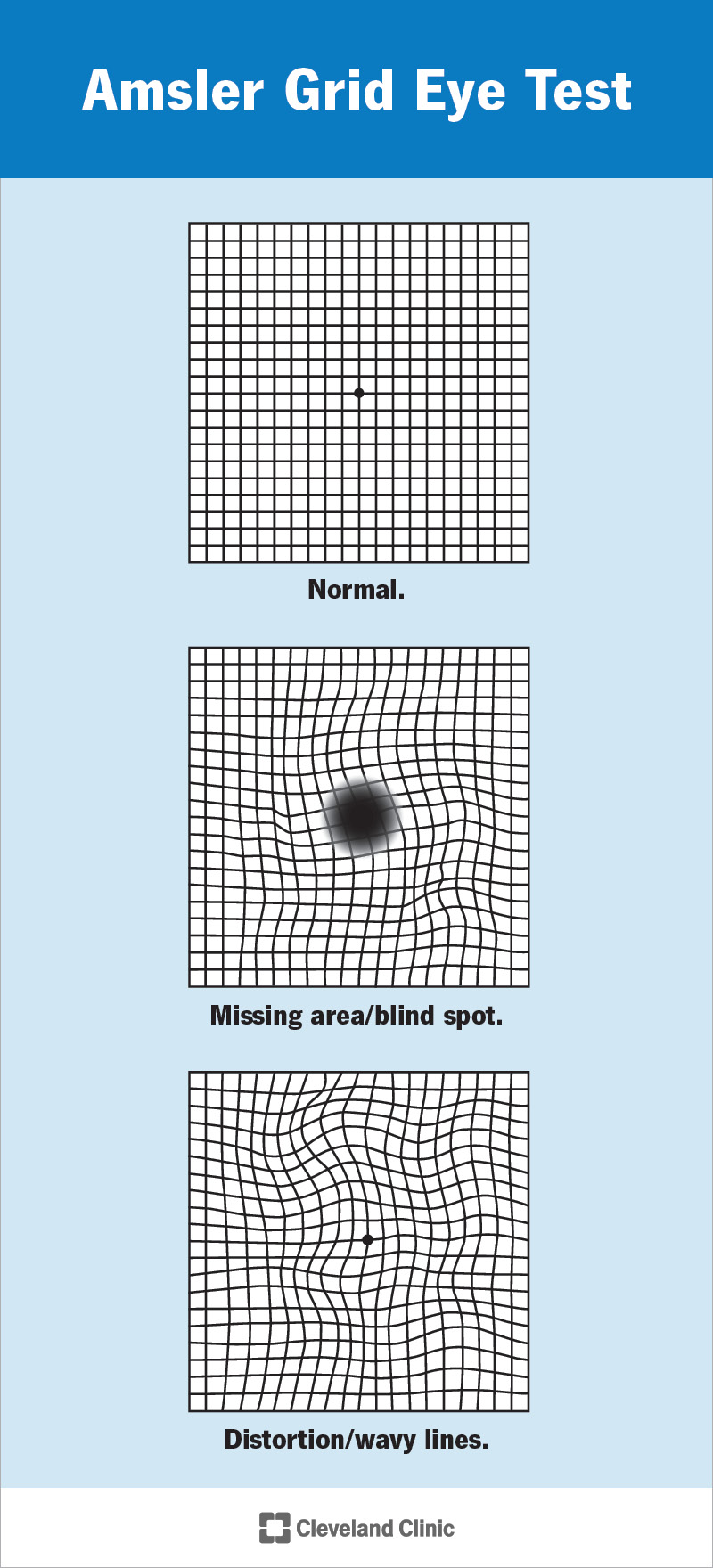 Amsler Grid Chart & Example