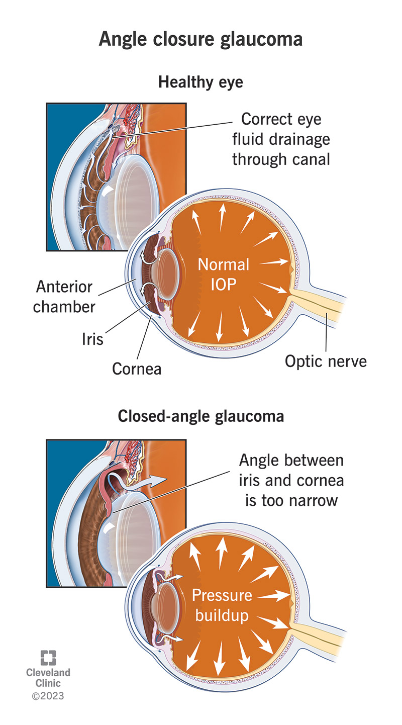 Angle-closure glaucoma is when the iris and lens press together and cause pressure inside the eye to increase.