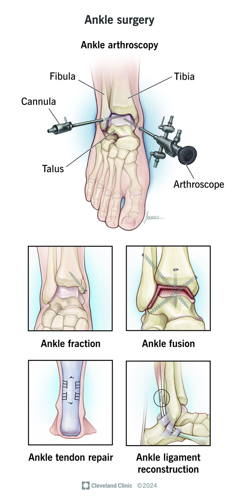 Many common ankle surgery procedures can be performed by minimally invasive arthroscopy.