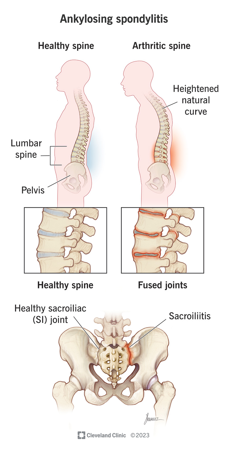 Ankylosing Spondylitis X Ray