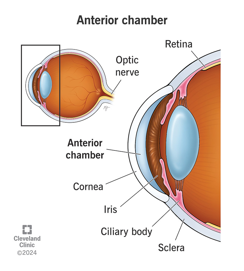 The anterior chamber is a fluid-filled space in your eye behind your cornea and in front of your iris