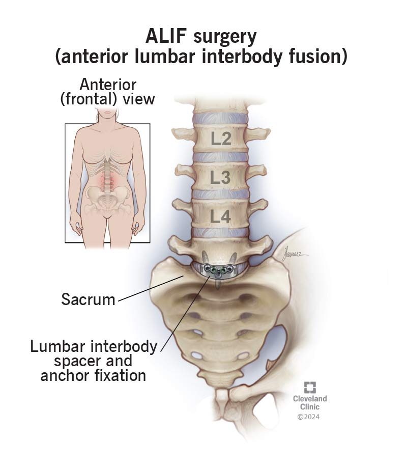 ALIF surgery relieves lower back pain by replacing damaged disks with bone grafts.