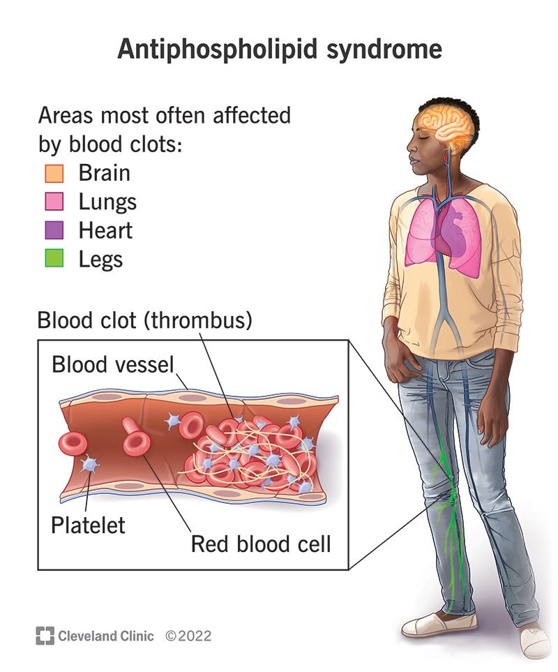 Antiphospholipid syndrome can cause blood clots throughout your body.