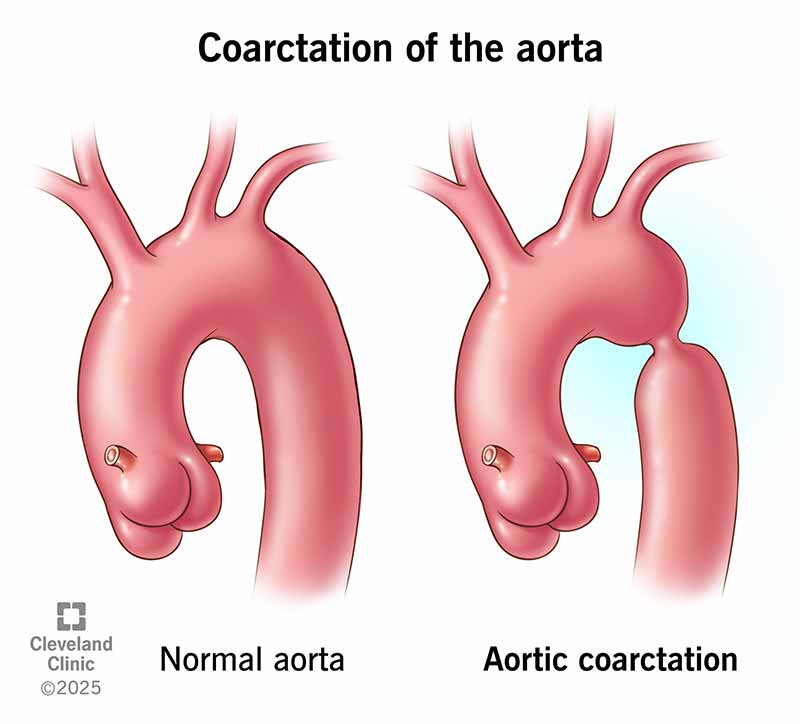 Coarctation of the aorta means your aorta is narrowed in one spot