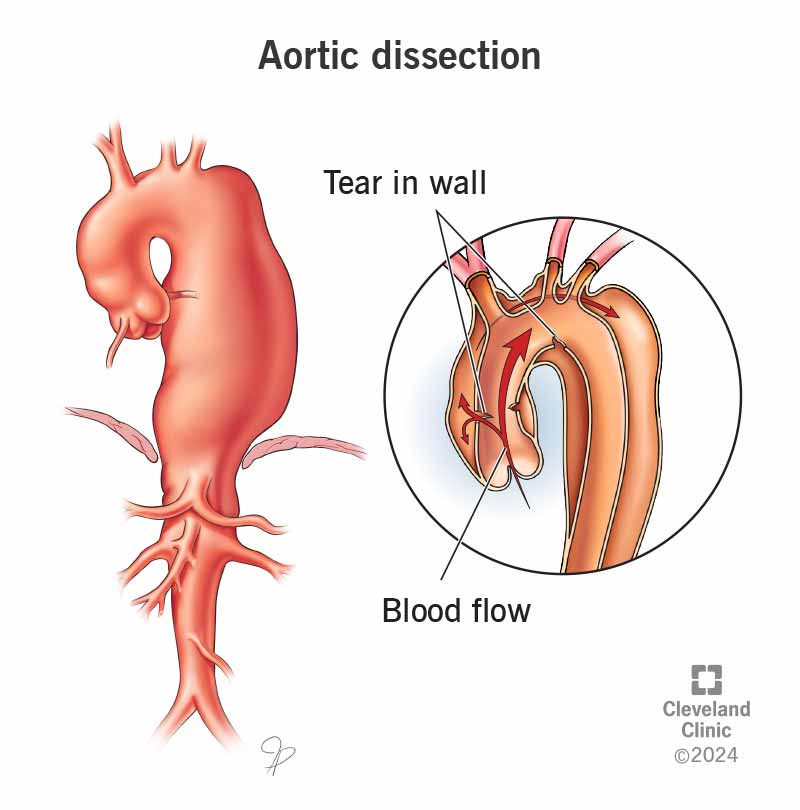 An aortic dissection is a tear in your aorta’s inner layer. This condition diverts blood between your aorta’s layers