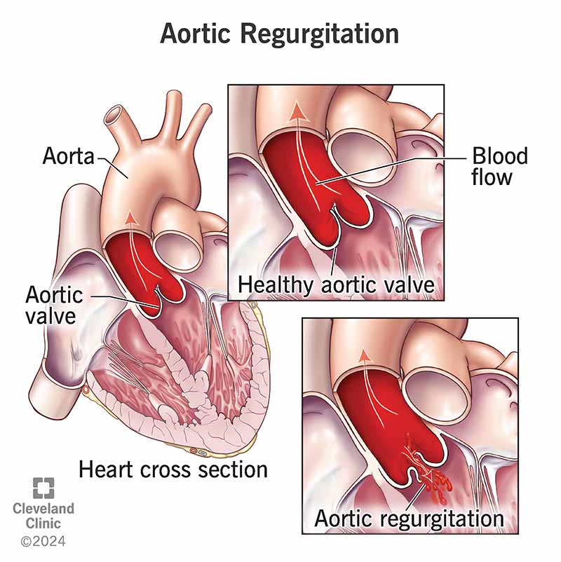 Unlike a healthy aortic valve, one with aortic regurgitation leaks blood because it doesn’t close tightly