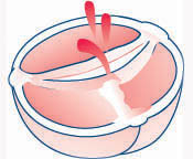 Bicuspid Aortic Valve - Two Leaflets