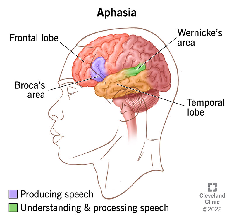 Aphasia affects areas of the brain that control your ability to speak and the words you use or how you understand them