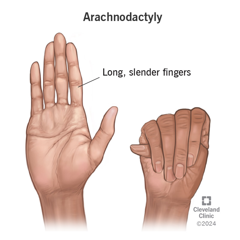 Illustration of unusually long, slender fingers (arachnodactyly).