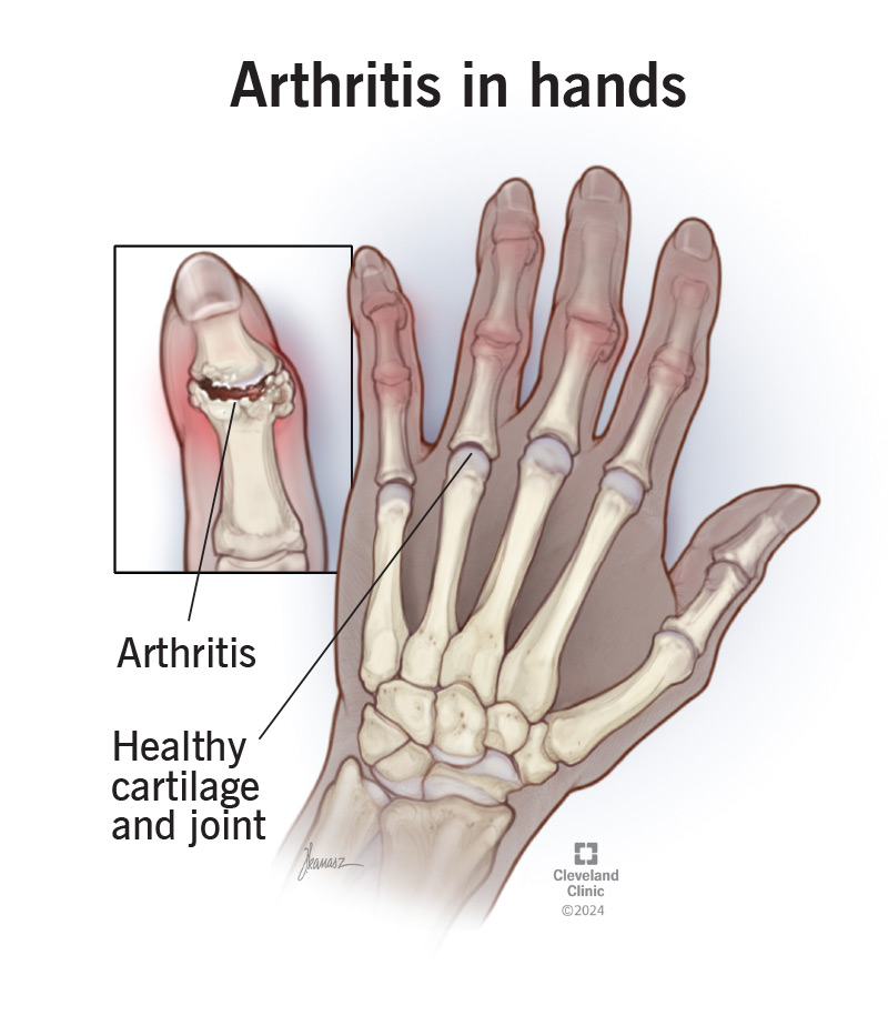 Arthritis causing inflammation in the joints in a left hand