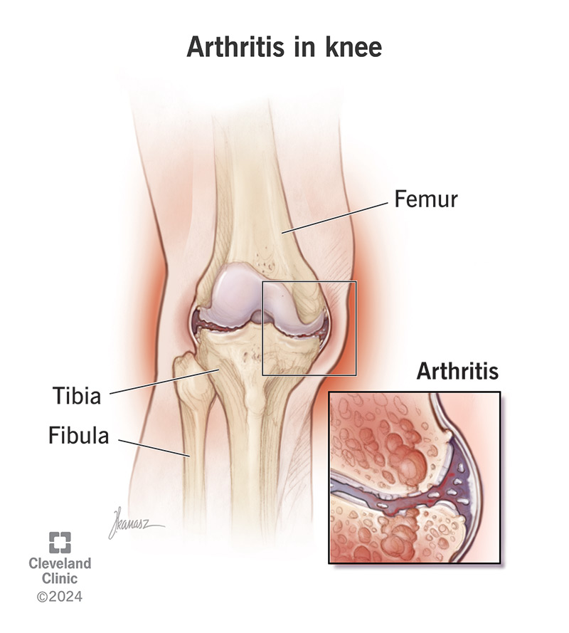 Illustration of arthritis in the knee, showing damage to the cartilage around the joint.