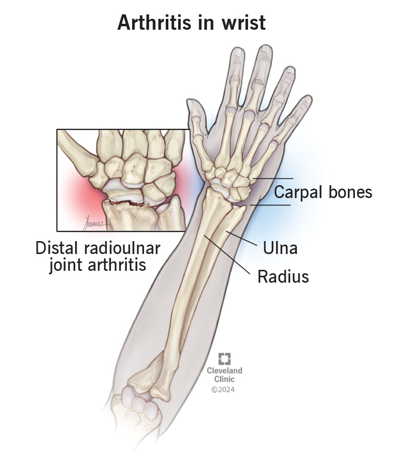 Illustration showing joints in your wrist where arthritis might occur.