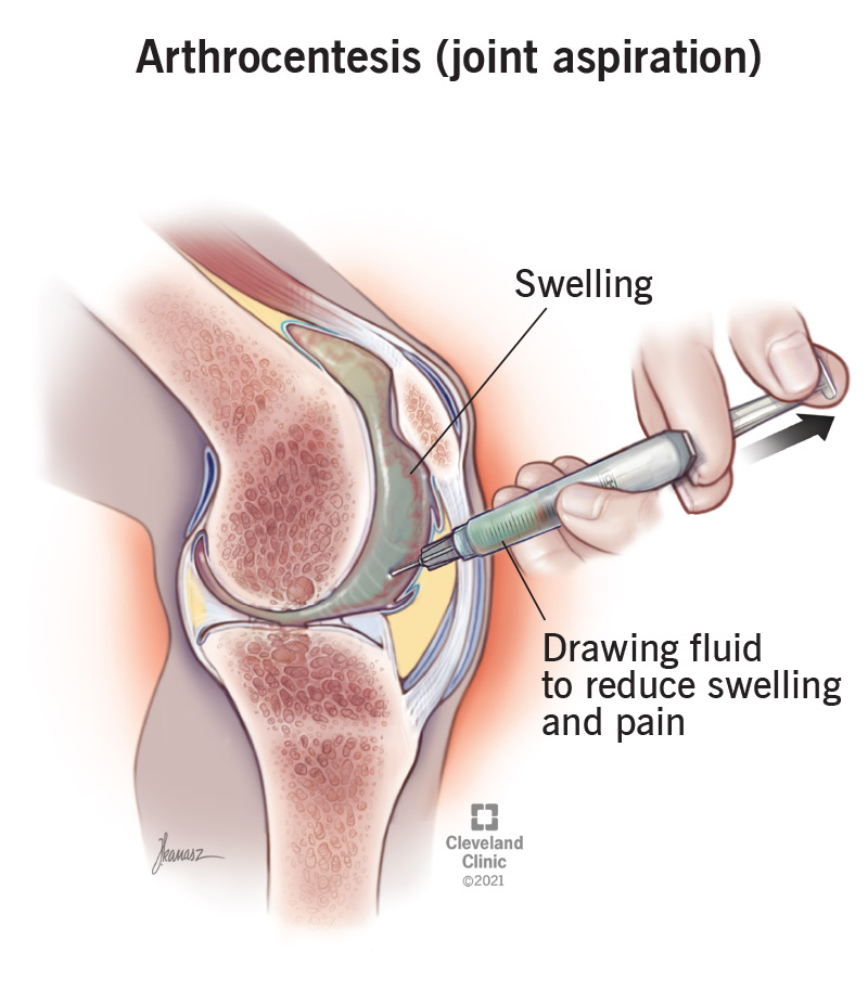 Illustration of a needle injected into a joint capsule (joint aspiration procedure).