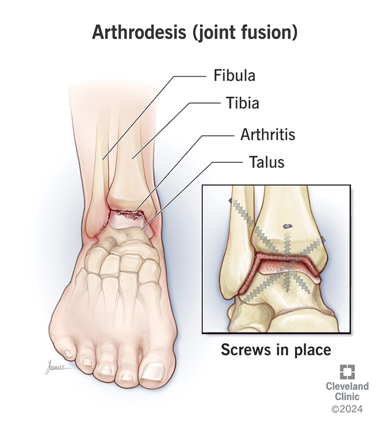 Ankles are some of the most common joints surgeons perform joint fusions on.
