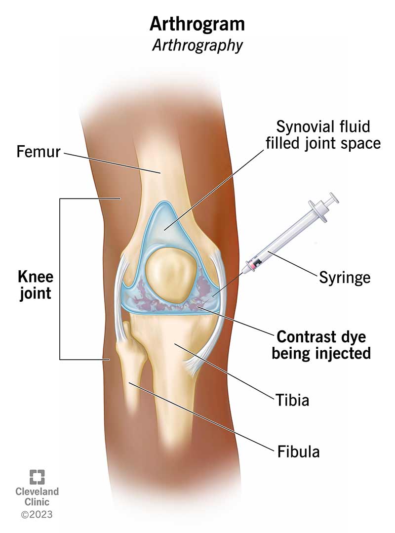 Knee joint being injected with contrast dye from a syringe