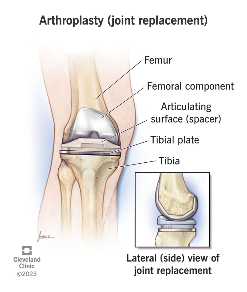 During a total joint replacement, your surgeon will replace all the parts of your joint with prosthetic pieces.