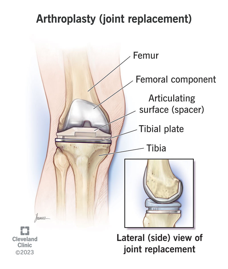 Total Hip Replacement: Types, Procedures, Recovery, Exercises