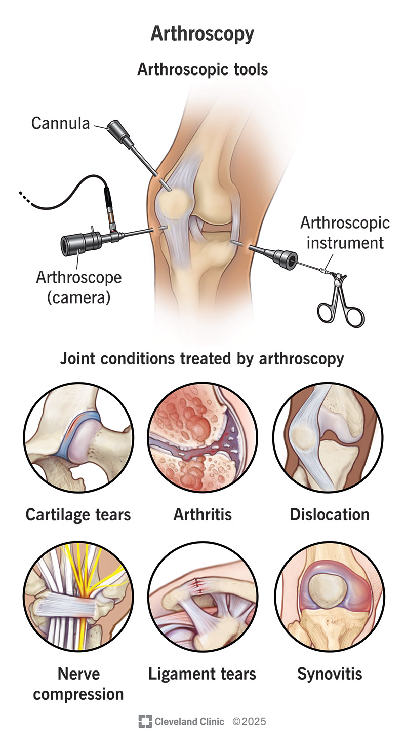 Arthroscopy is minimally invasive surgery on a joint. Surgeons use small incisions and long tools to operate.
