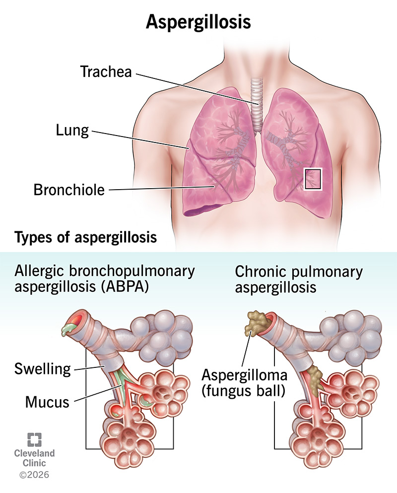 Lung anatomy, with aspergillosis in airways, causing swelling, mucus and fungus ball formation
