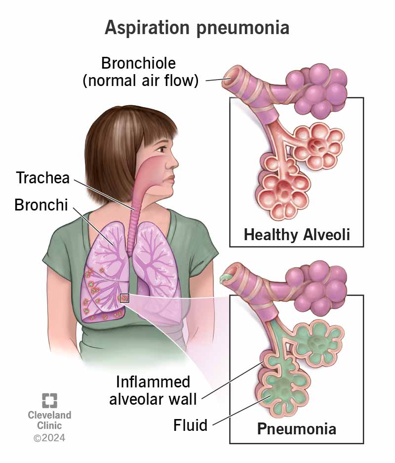 Illustration of healthy air sacs in your lungs and air sacs that are inflamed and filled with fluid, indicating pneumonia.