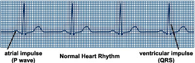 Atrial Fibrillation (Afib) | Cleveland Clinic: Health Library