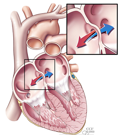 Atrial Septal Defect (ASD): Symptoms, Causes, Tests and Treatments