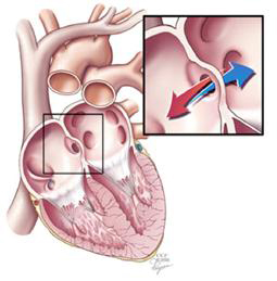 Atriyal Septal Defekt (ASD)