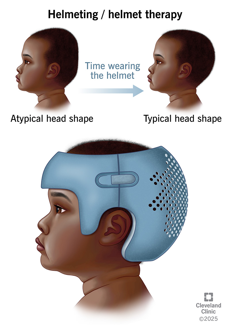A baby wearing a custom-fitted helmet to help gently mold their skull into a more typical shape