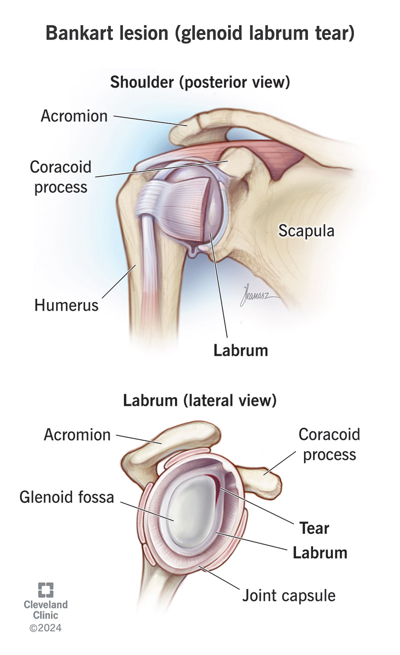 A Bankart lesion is a tear in the cartilage that holds your shoulder joint together.
