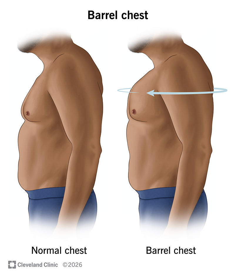 Barrel chest is when your rib cage extends out into a rounded shape like a barrel